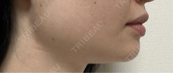 ボトックス（エラ・小顔） TCB東京中央美容外科 自由が丘院 DAY 4 メイン用