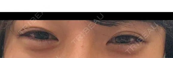 ヒアルロン酸注入（涙袋） / シワ取りボトックス / ヒアルロン酸注入（鼻翼基部） 東京シルククリニック 東京神田院 DAY 0 メイン用