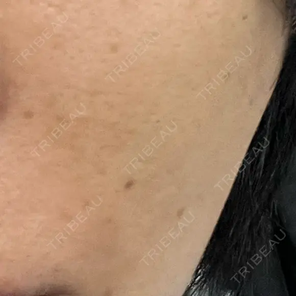 ピコレーザートーニング（美白・肝斑） / ピコフラクショナルレーザー（毛穴・ニキビ跡） おおかみ美容のクリニック 新宿院 AFTER メイン用