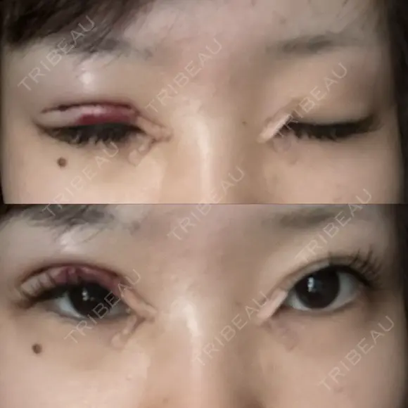 目頭切開 / 眼瞼下垂（切開） サラ美容外科 DAY 1 メイン用