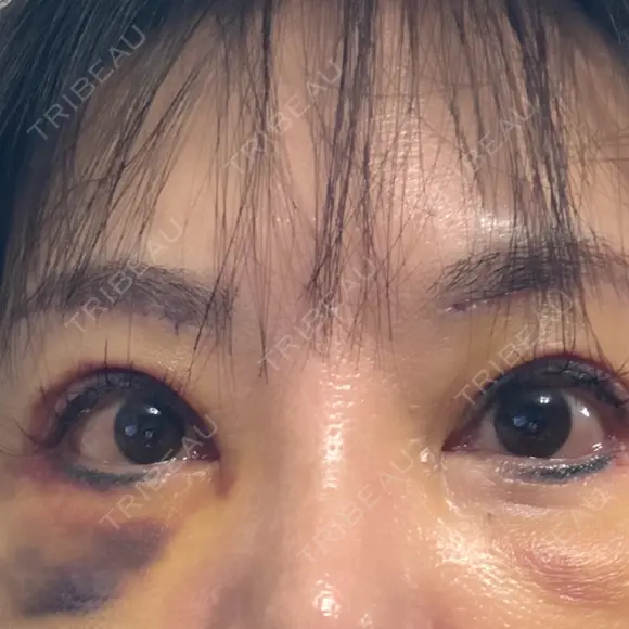 眉下切開 MOMO CLINIC DAY 5 メイン用