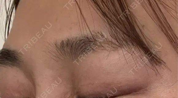 ボトックス（眉間） 札幌TAクリニック DAY 3 メイン用