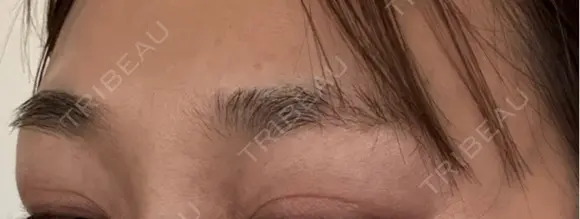 ボトックス（眉間） 札幌TAクリニック DAY 4 メイン用