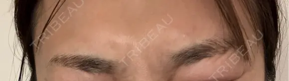 ボトックス（眉間） 札幌TAクリニック DAY 5 メイン用