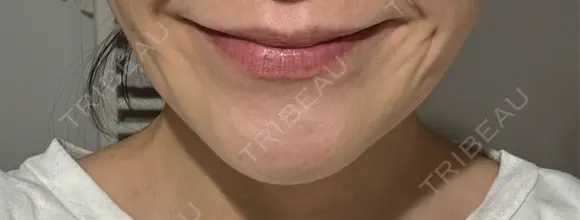 ボトックス（エラ・小顔） 札幌TAクリニック DAY 5 メイン用