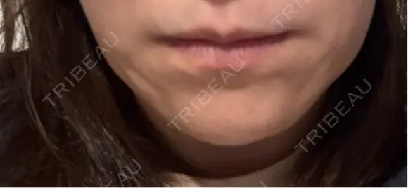 ボトックス（エラ・小顔） 札幌TAクリニック DAY 2 メイン用