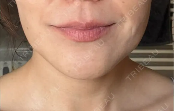 ボトックス（エラ・小顔） 札幌TAクリニック DAY 3 メイン用