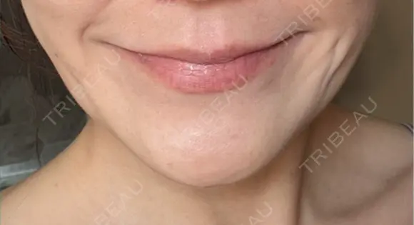 ボトックス（エラ・小顔） 札幌TAクリニック DAY 4 メイン用