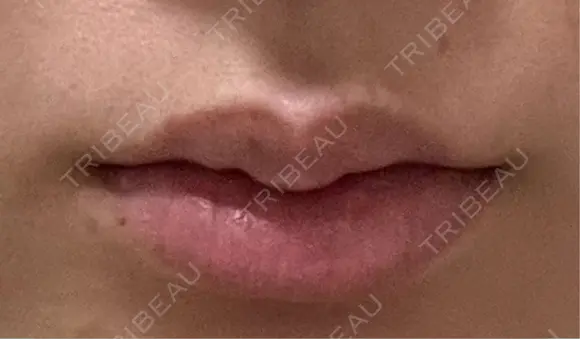 ヒアルロン酸注入（唇） 目白ホワイトクリニック AFTER メイン用