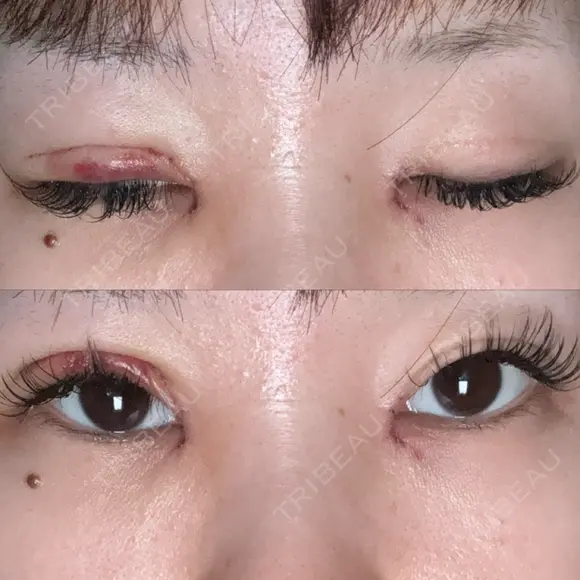 目頭切開 / 眼瞼下垂（切開） サラ美容外科 DAY 2 メイン用