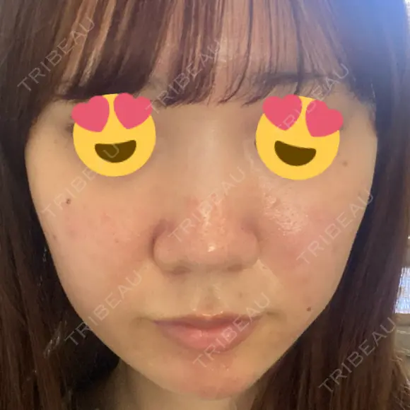 毛穴洗浄（ハイドラフェイシャルなど） DAILY SKIN CLINIC 心斎橋院 DAY 0 メイン用