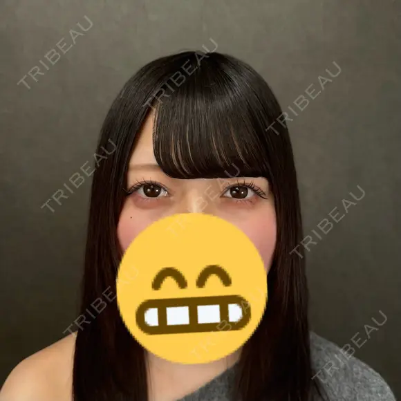 二重埋没 ネビュラクリニック 京都院 AFTER メイン用