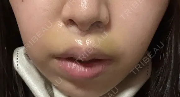 人中短縮 YBC横浜美容外科 池袋院 DAY 5 メイン用