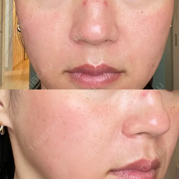 ヴェルヴェットスキン RainBoW Clinic TOKYO DAY 0 メイン用