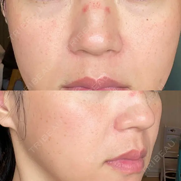 ヴェルヴェットスキン RainBoW Clinic TOKYO DAY 1 メイン用