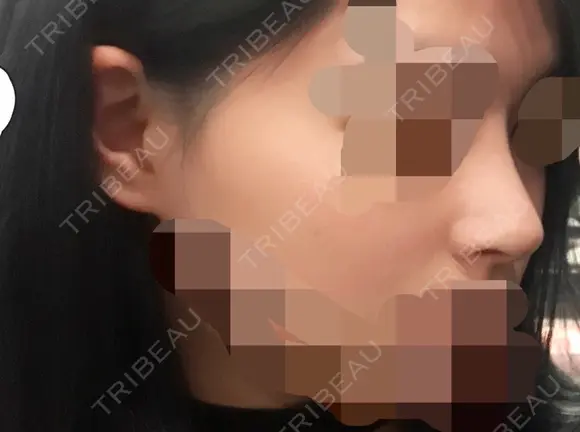 隆鼻術 / 鼻尖形成（切開） / 鼻中隔延長（切開） / 鼻尖縮小 FROM B整形外科 (旧バウム整形外科) DAY 18 メイン用