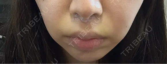 人中短縮 YBC横浜美容外科 池袋院 DAY 6 メイン用