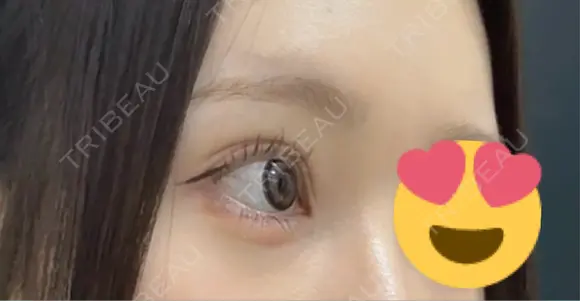 二重埋没 / 目尻切開 / 自然癒着法 Stand by Beauty Clinic DAY 21 メイン用