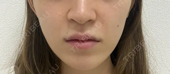 肌ヒアルロン酸注入（たるみ・シワ改善） EMMO FACE CLINIC 東京三田院 DAY 0 メイン用