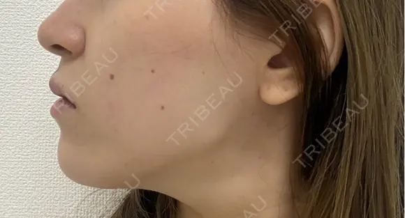 肌ヒアルロン酸注入（たるみ・シワ改善） EMMO FACE CLINIC 東京三田院 DAY 0 メイン用