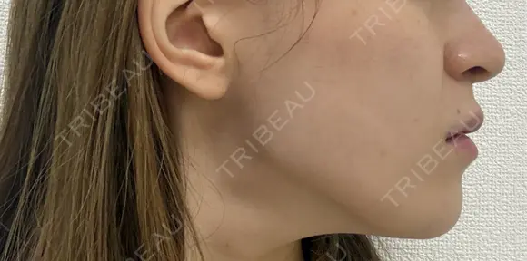 肌ヒアルロン酸注入（たるみ・シワ改善） EMMO FACE CLINIC 東京三田院 DAY 0 メイン用