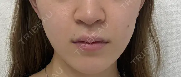 肌ヒアルロン酸注入（たるみ・シワ改善） EMMO FACE CLINIC 東京三田院 DAY 1 メイン用