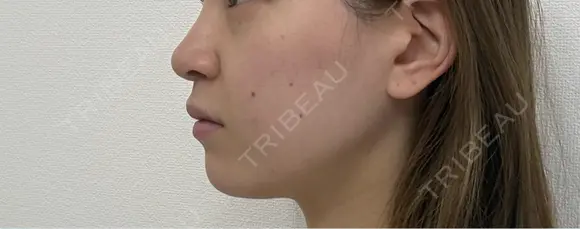 肌ヒアルロン酸注入（たるみ・シワ改善） EMMO FACE CLINIC 東京三田院 DAY 1 メイン用