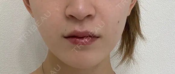 肌ヒアルロン酸注入（たるみ・シワ改善） EMMO FACE CLINIC 東京三田院 AFTER メイン用