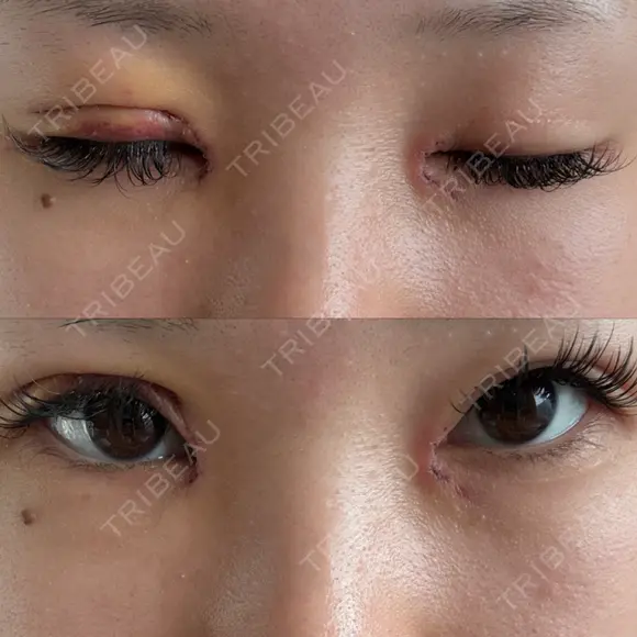 目頭切開 / 眼瞼下垂（切開） サラ美容外科 DAY 3 メイン用