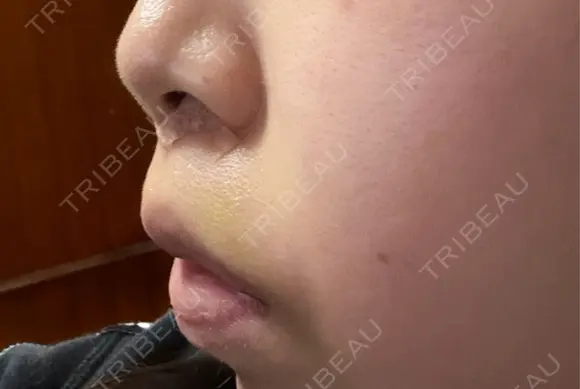 人中短縮 YBC横浜美容外科 池袋院 DAY 6 メイン用