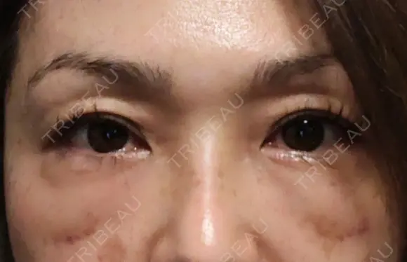 下まぶたたるみ取り 湘南美容クリニック 千葉センシティ院 DAY 14 メイン用