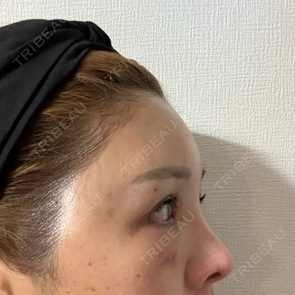 脂肪注入（額） plume clinic DAY 20 メイン用