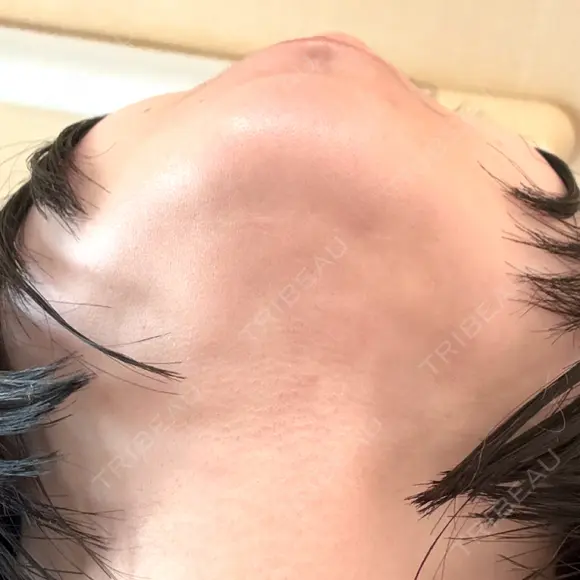 二重埋没 / 目頭切開 / 糸リフト / クマ治療 / 脂肪吸引（顔） / 上まぶたの脂肪取り / ジョールファット除去 ルラ美容クリニック 渋谷本院 DAY 40 メイン用