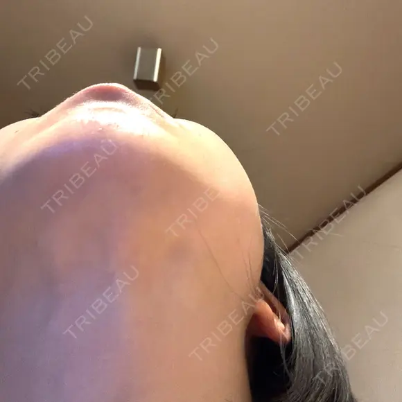 二重埋没 / 目頭切開 / 糸リフト / クマ治療 / 脂肪吸引（顔） / 上まぶたの脂肪取り / ジョールファット除去 ルラ美容クリニック 渋谷本院 DAY 41 メイン用