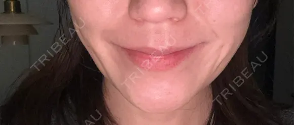 ボトックス（エラ・小顔） 札幌TAクリニック DAY 6 メイン用