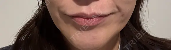 ボトックス（エラ・小顔） 札幌TAクリニック DAY 7 メイン用