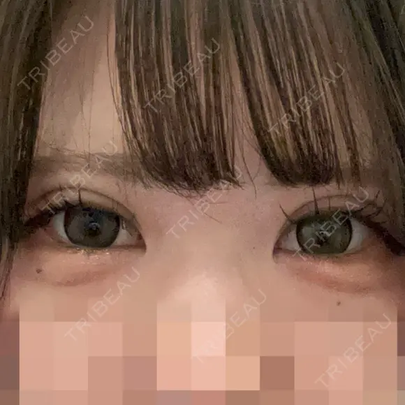 二重埋没 / ヒアルロン酸注入（涙袋） アリエル美容クリニック 郡山院 DAY 0 メイン用