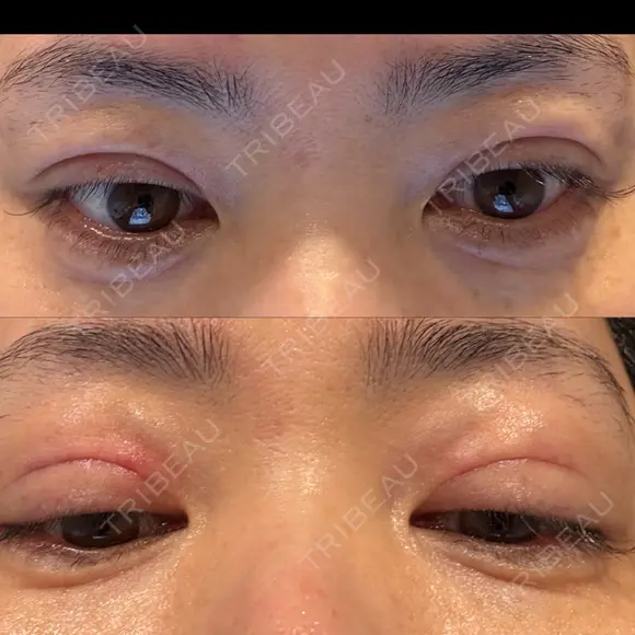 二重埋没 KIMI CLINIC 形成・美容外科 AFTER メイン用