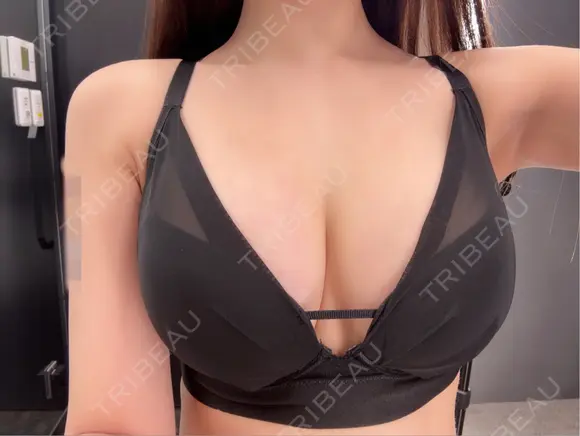 脂肪吸引（脚） / 豊胸（脂肪注入） GRACIA clinic 【グラシアクリニック】 DAY 103 メイン用