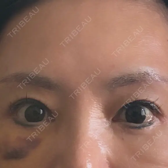 眉下切開 MOMO CLINIC DAY 8 メイン用