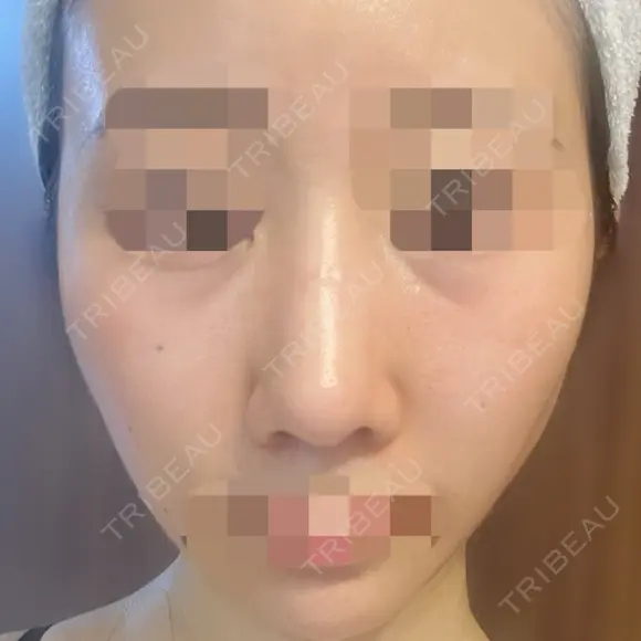 鼻尖形成（切開） / 鼻中隔延長（切開） / 軟骨移植 / 骨切幅寄せ / ワシ鼻修正・ハンプ切除 / 斜鼻修正 / 鼻修正 リッツ美容外科 東京院 AFTER メイン用