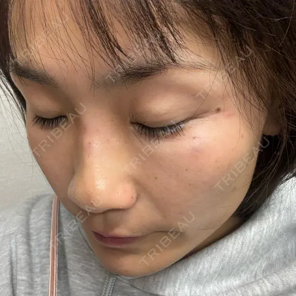 ボトックス（あご） / ボトックス（エラ・小顔） / ボトックス（肩） / ボトックス（眉間） / ボトックス（目尻） / ボトックス（額） / ボトックス（人中） / ボトックス（バニーライン） おおたかの森ビューティークリニック DAY 0 メイン用