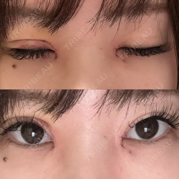 目頭切開 / 眼瞼下垂（切開） サラ美容外科 DAY 4 メイン用