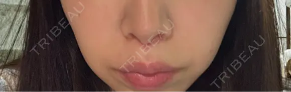 人中短縮 YBC横浜美容外科 池袋院 DAY 7 メイン用