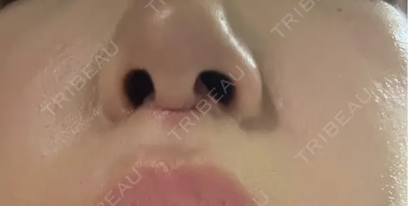 人中短縮 YBC横浜美容外科 池袋院 DAY 7 メイン用