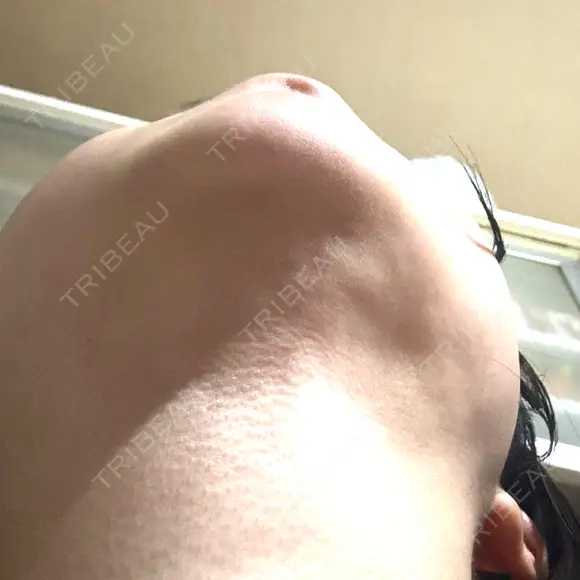 二重埋没 / 目頭切開 / 糸リフト / クマ治療 / 脂肪吸引（顔） / 上まぶたの脂肪取り / ジョールファット除去 ルラ美容クリニック 渋谷本院 DAY 42 メイン用