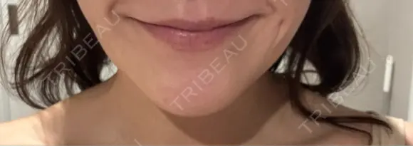 ボトックス（エラ・小顔） 札幌TAクリニック DAY 8 メイン用