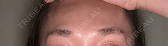 ボトックス（眉間） 札幌TAクリニック DAY 7 メイン用