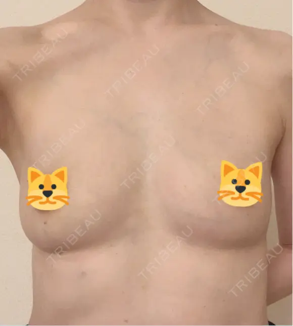 豊胸（脂肪注入） / 脂肪注入（額） / 乳頭縮小 アールクリニック DAY 31 メイン用