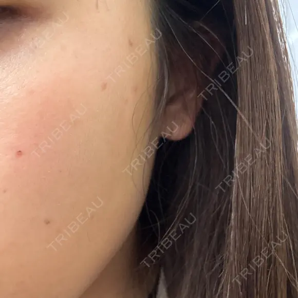 ルメッカ おおかみ美容のクリニック 新宿院 DAY 0 メイン用